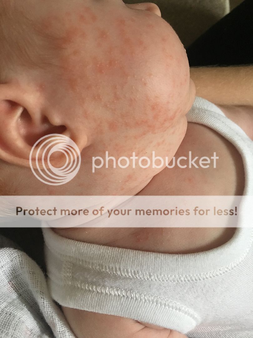 Rash on face and neck BabyCenter