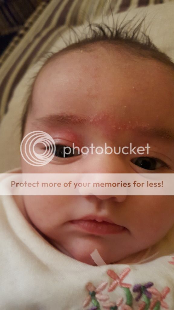 Red marks + dry flaky skin- birthmark? Picture | BabyCentre